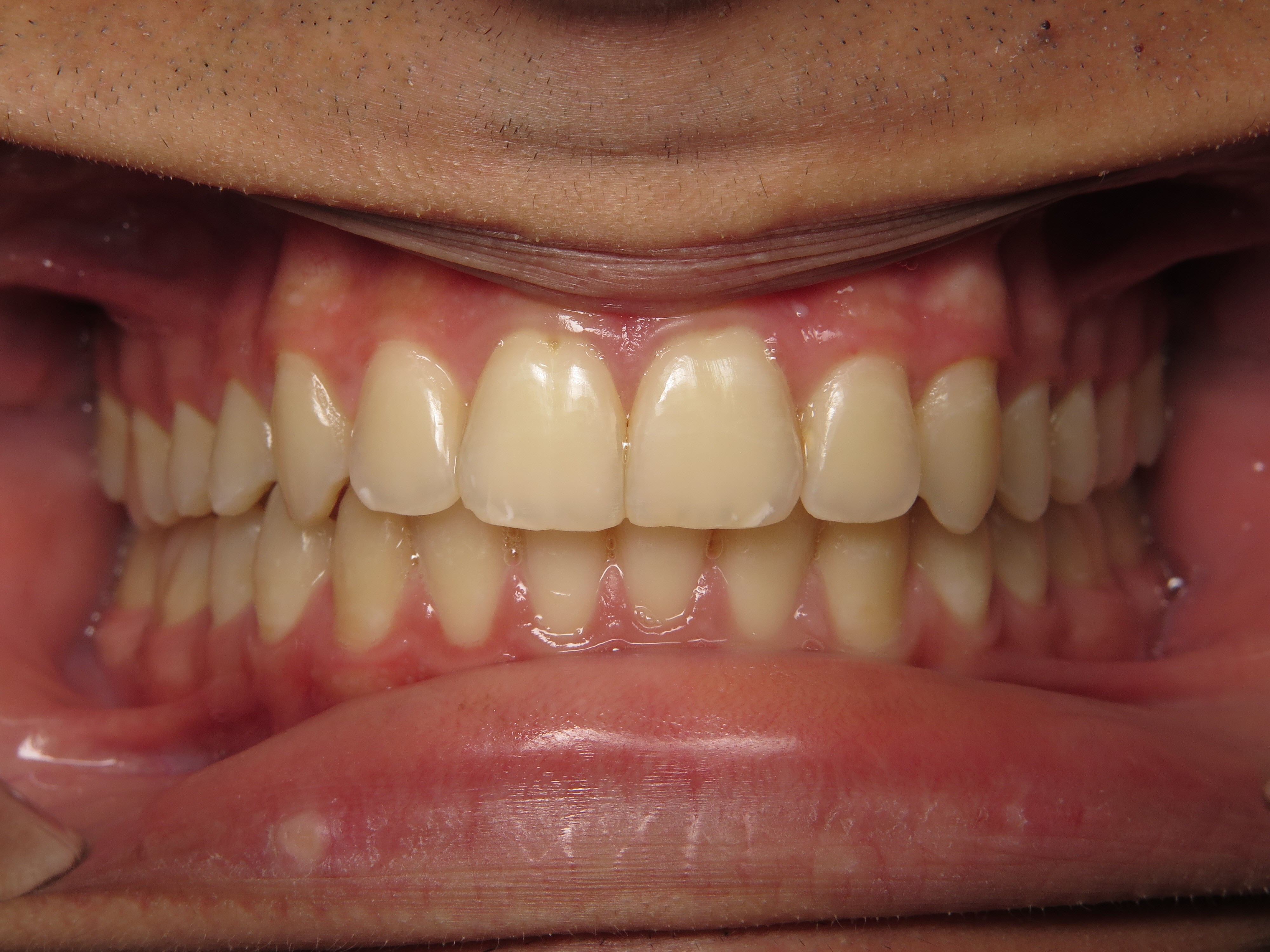 An after image of teeth