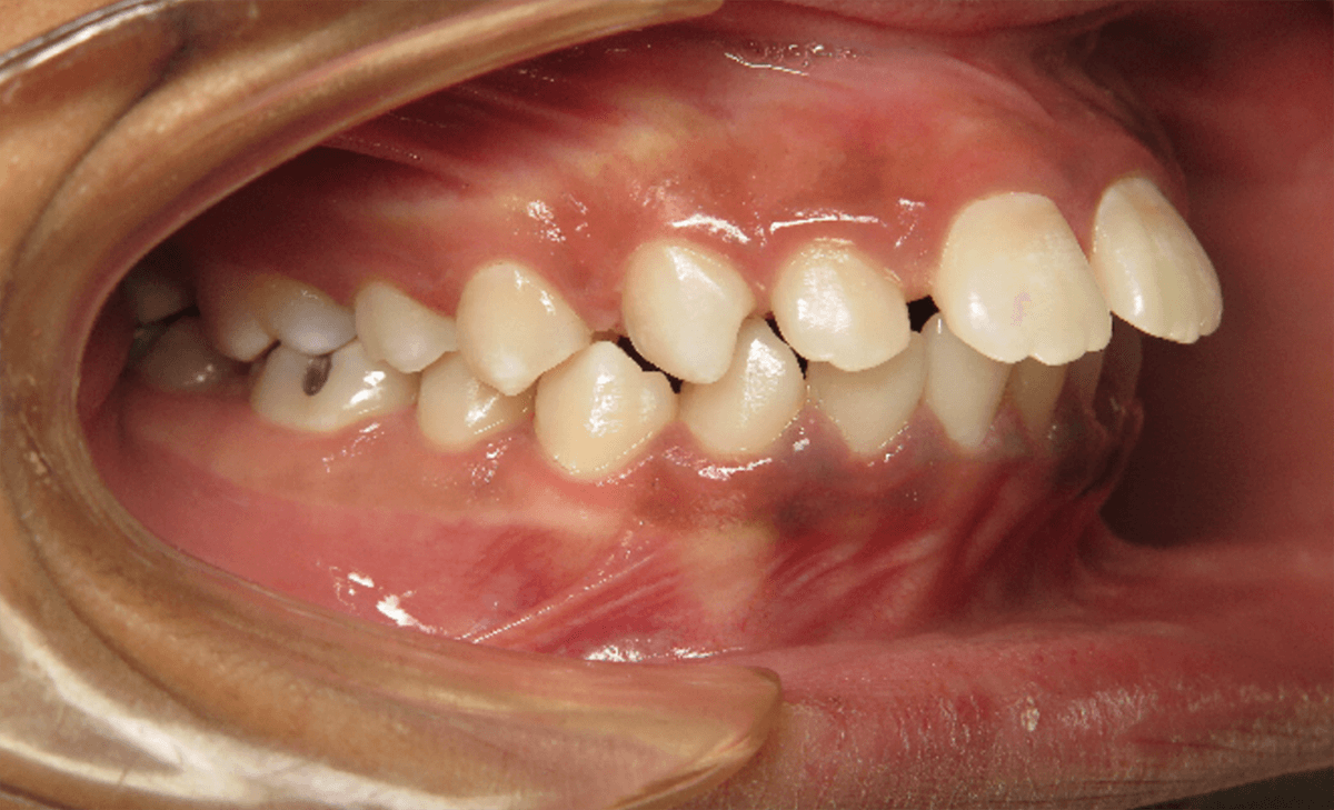 A before image of teeth