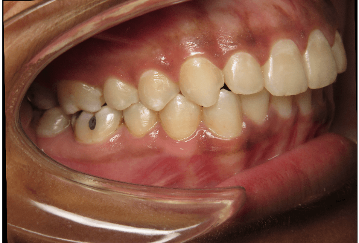 An after image of teeth
